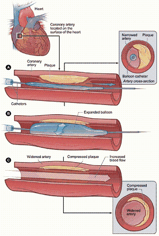 angioplasty